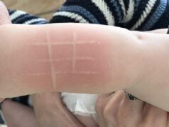 ¿Con el frío aumentan las urticarias? Síntomas, tipos y cómo prevenir el picor