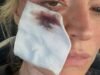 Laura Woods comparte imágenes gráficas de horrorosas lesiones faciales después de un extraño accidente
